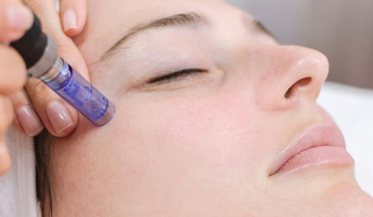 Tratamiento de Microagujas y Dermapen en Cali