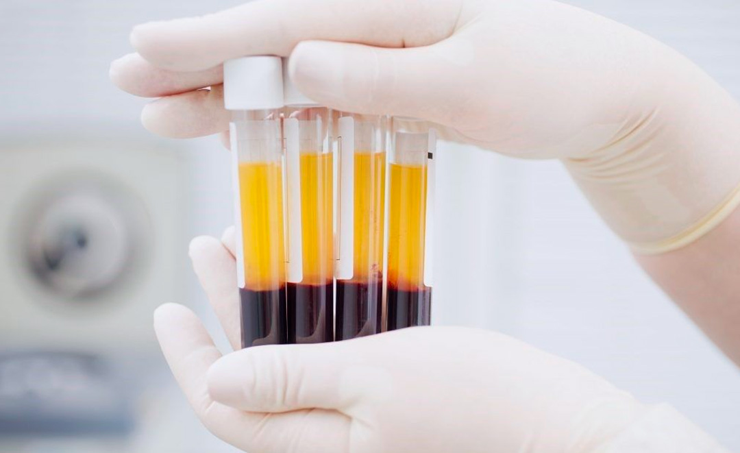 Plasma Rico en Plaquetas (PRP) en Cali