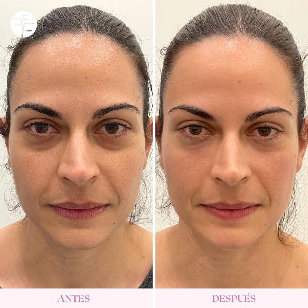 Antes de la revitalización facial